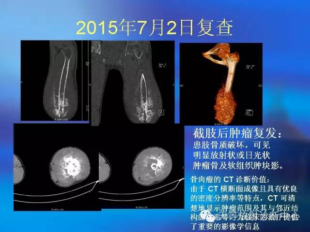 影像PPT - 【病例】骨肉瘤2例影像学表现-3 影像PPT - 【病例】骨肉瘤2例影像学表现-3