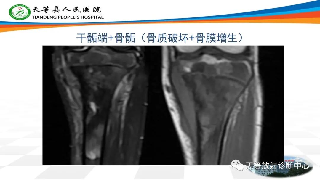 影像PPT - 【病例】骨肉瘤2例影像学表现-11 影像PPT - 【病例】骨肉瘤2例影像学表现-11