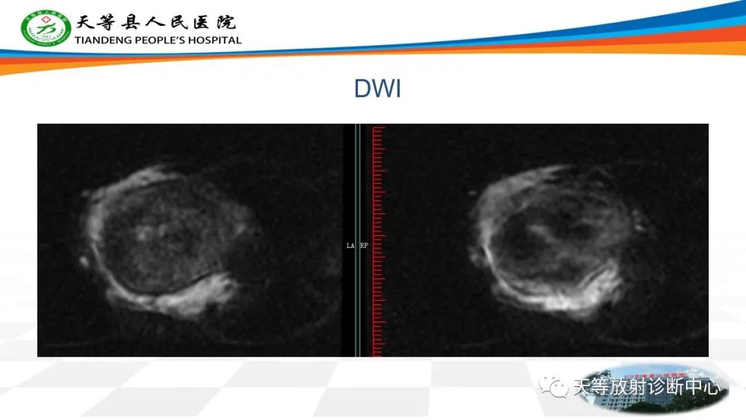 影像PPT - 【病例】骨肉瘤2例影像学表现-12 影像PPT - 【病例】骨肉瘤2例影像学表现-12
