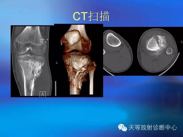 影像PPT - 【病例】骨肉瘤2例影像学表现-2 影像PPT - 【病例】骨肉瘤2例影像学表现-2