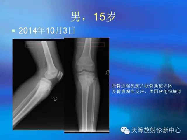 影像PPT - 【病例】骨肉瘤2例影像学表现-1 影像PPT - 【病例】骨肉瘤2例影像学表现-1