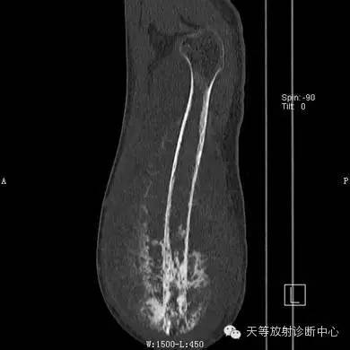 影像PPT - 【病例】骨肉瘤2例影像学表现-7 影像PPT - 【病例】骨肉瘤2例影像学表现-7