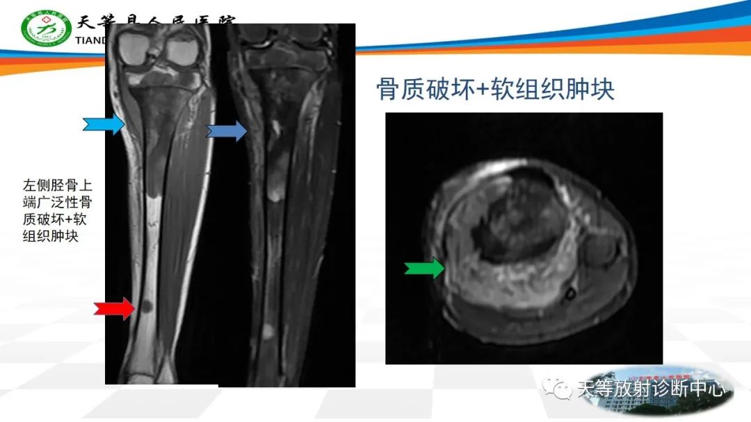 影像PPT - 【病例】骨肉瘤2例影像学表现-10 影像PPT - 【病例】骨肉瘤2例影像学表现-10