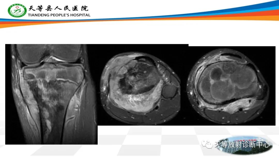 影像PPT - 【病例】骨肉瘤2例影像学表现-13 影像PPT - 【病例】骨肉瘤2例影像学表现-13