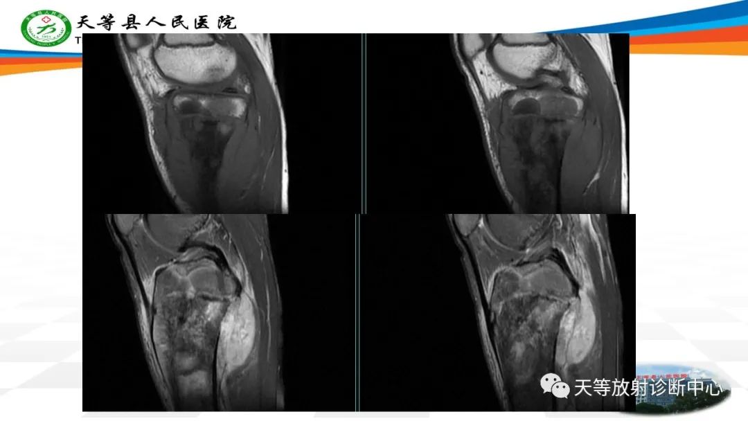 影像PPT - 【病例】骨肉瘤2例影像学表现-14 影像PPT - 【病例】骨肉瘤2例影像学表现-14