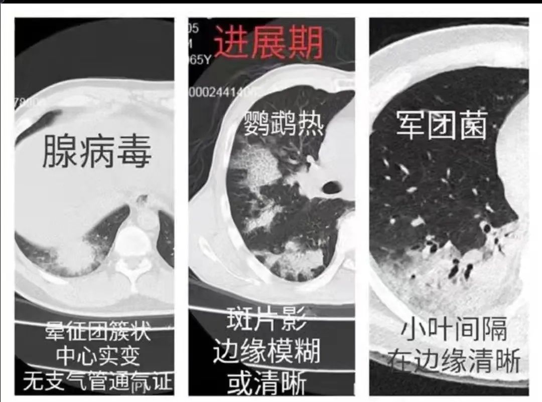 影像PPT - 【病例】鹦鹉热衣原体肺炎1例CT影像-34 影像PPT - 【病例】鹦鹉热衣原体肺炎1例CT影像-34