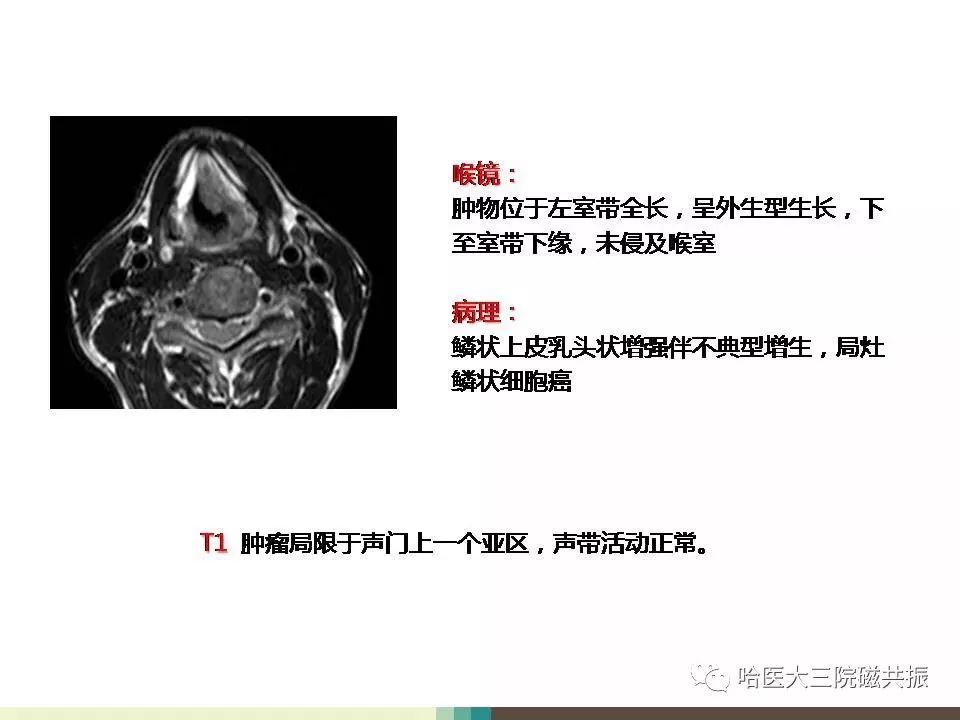 影像PPT - 【PPT】喉癌与磁共振成像-9