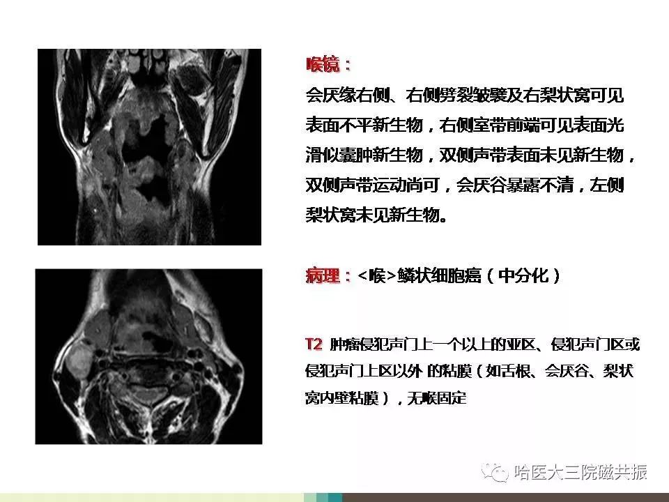 影像PPT - 【PPT】喉癌与磁共振成像-10