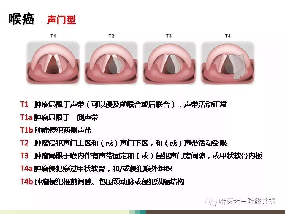 影像PPT - 【PPT】喉癌与磁共振成像-12