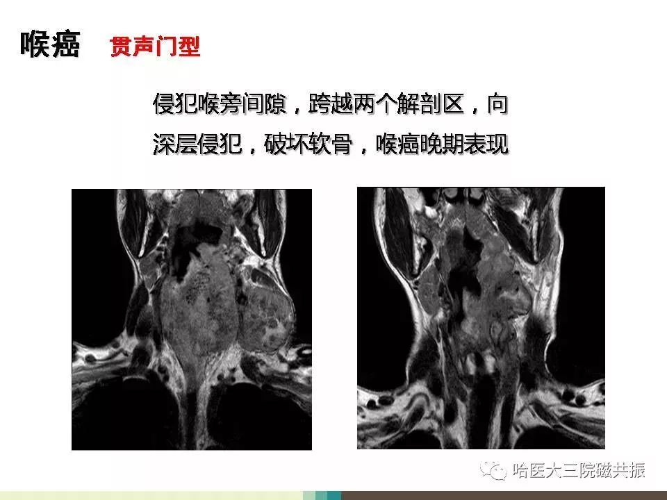 影像PPT - 【PPT】喉癌与磁共振成像-14