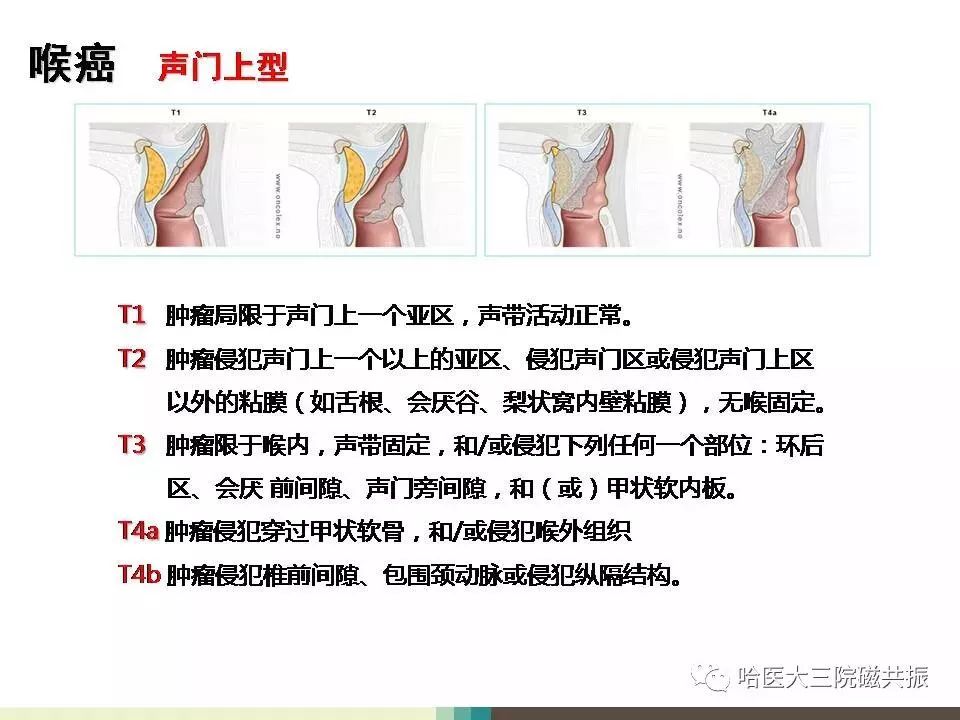 影像PPT - 【PPT】喉癌与磁共振成像-8