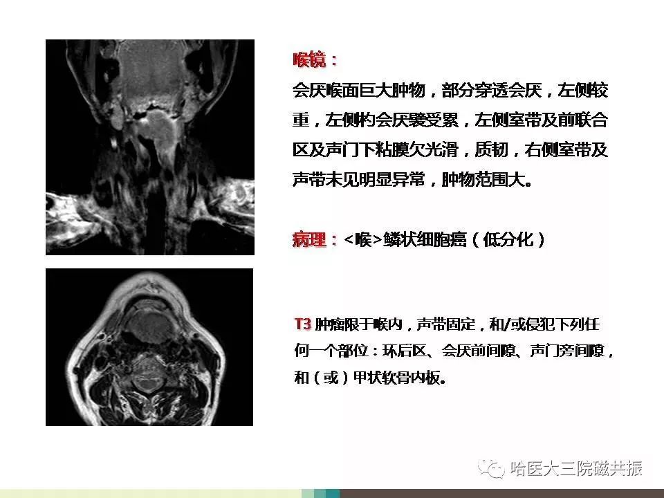 影像PPT - 【PPT】喉癌与磁共振成像-11