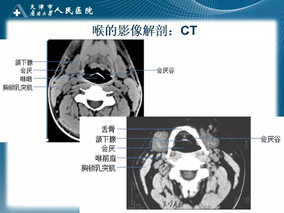 影像PPT - 【PPT】喉的应用解剖与影像解剖-18