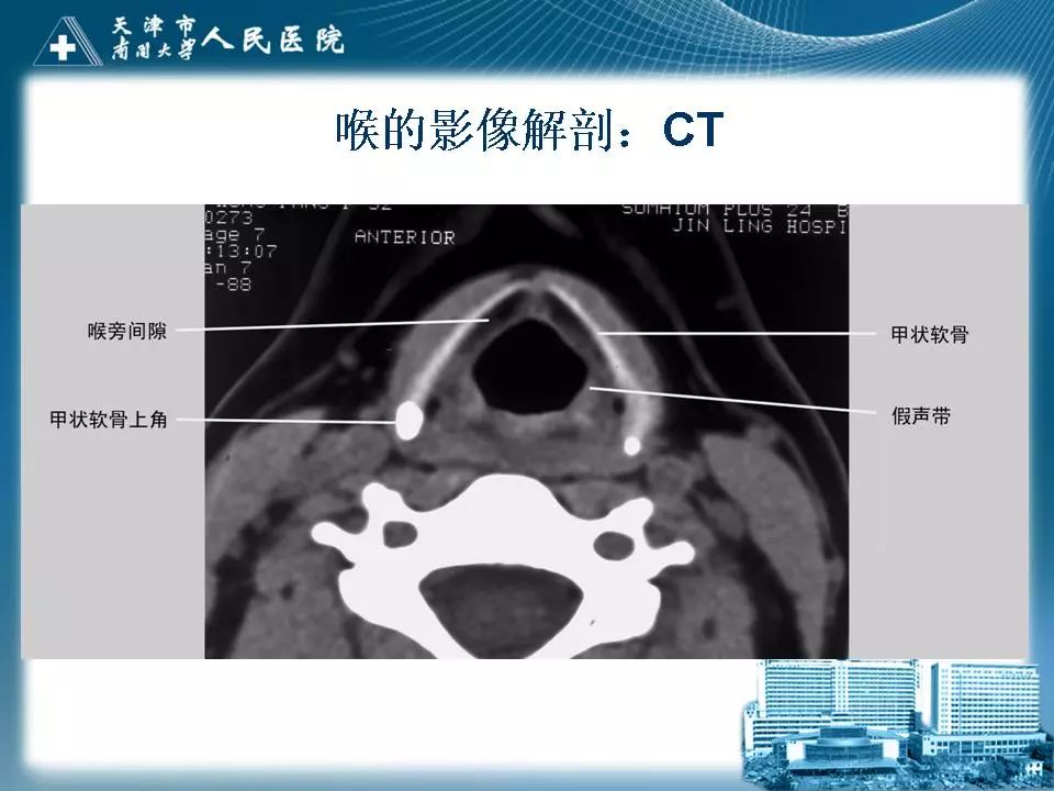 影像PPT - 【PPT】喉的应用解剖与影像解剖-20