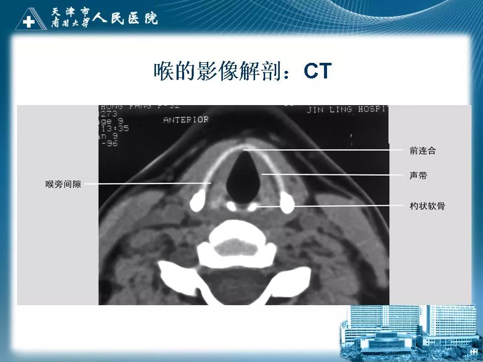 影像PPT - 【PPT】喉的应用解剖与影像解剖-21
