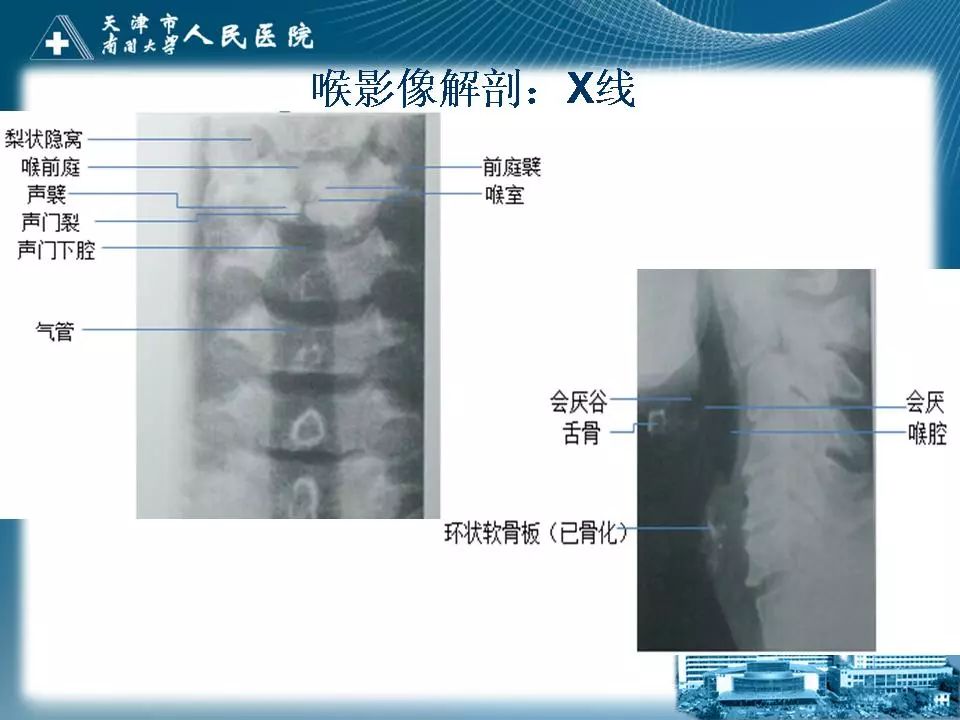 影像PPT - 【PPT】喉的应用解剖与影像解剖-17