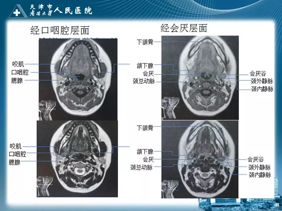 影像PPT - 【PPT】喉的应用解剖与影像解剖-26