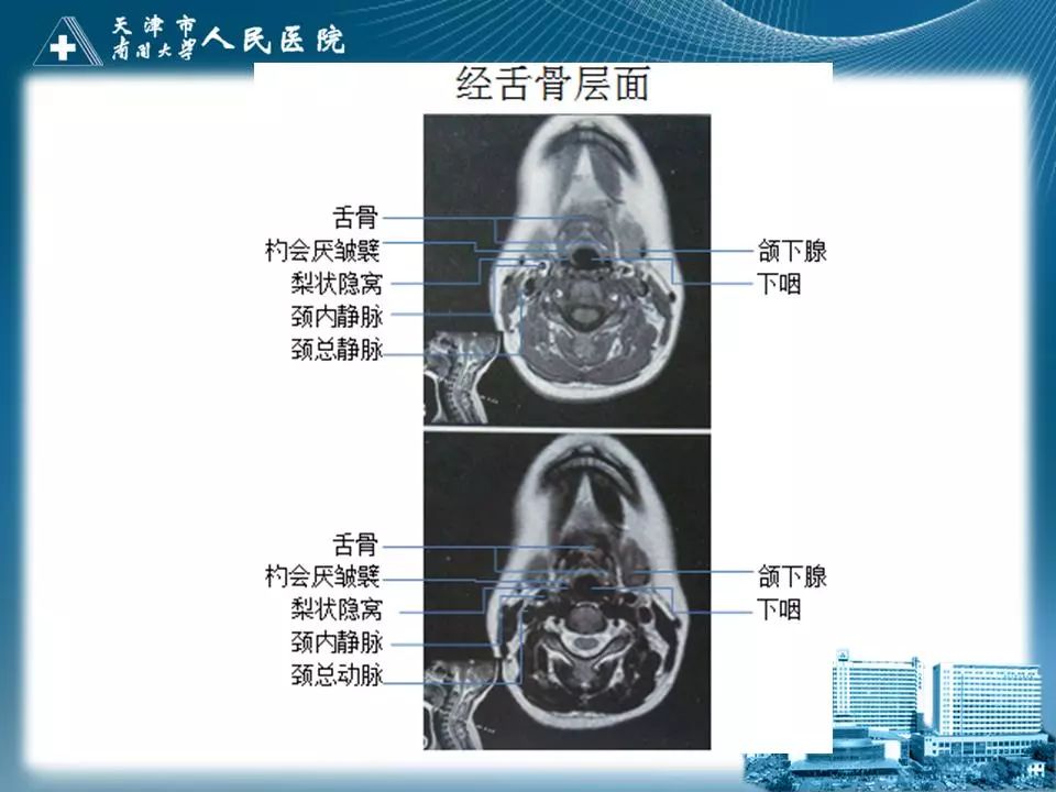 影像PPT - 【PPT】喉的应用解剖与影像解剖-27