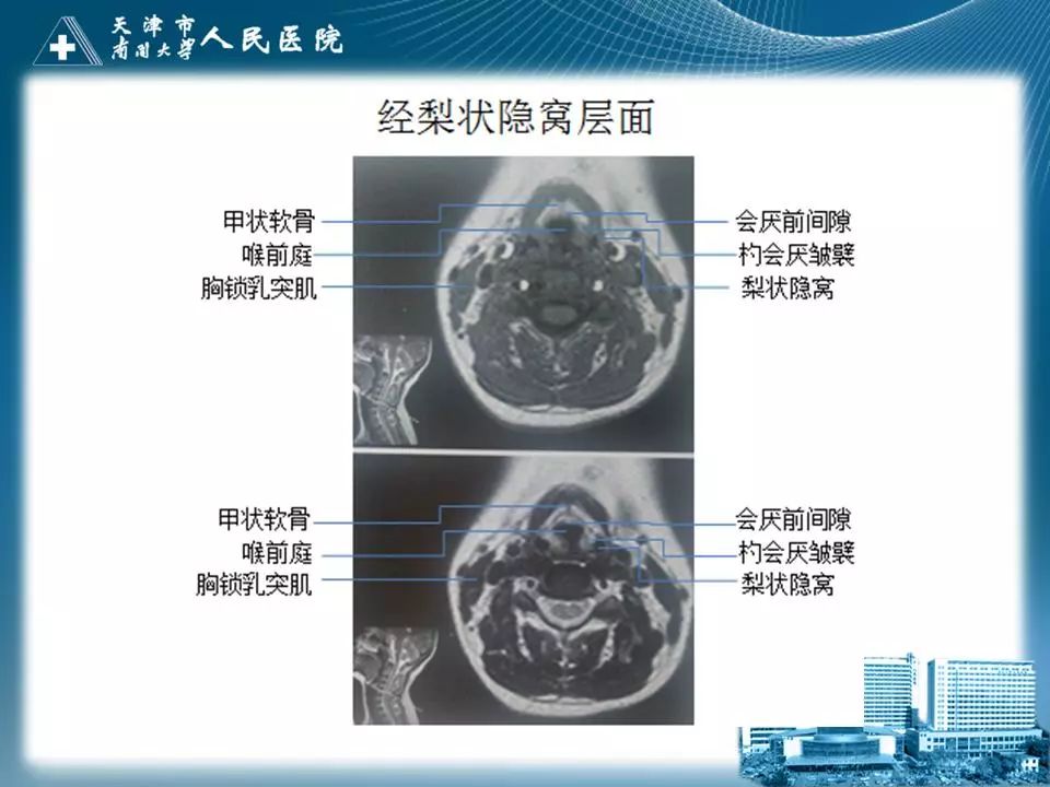 影像PPT - 【PPT】喉的应用解剖与影像解剖-28
