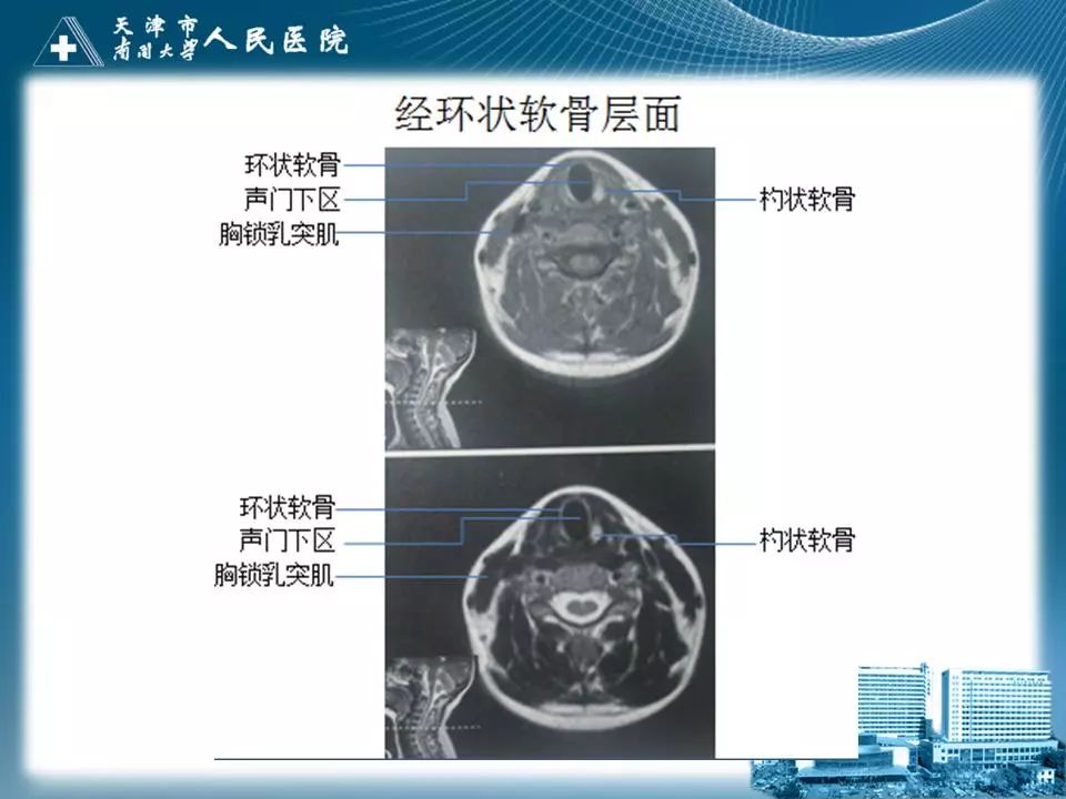 影像PPT - 【PPT】喉的应用解剖与影像解剖-31