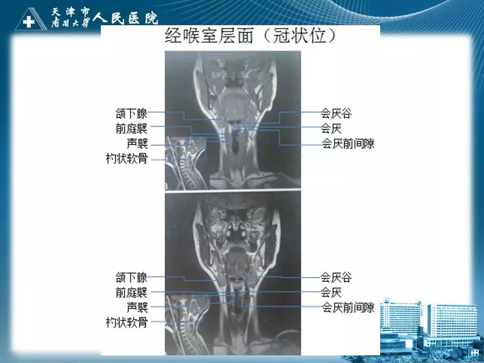 影像PPT - 【PPT】喉的应用解剖与影像解剖-32