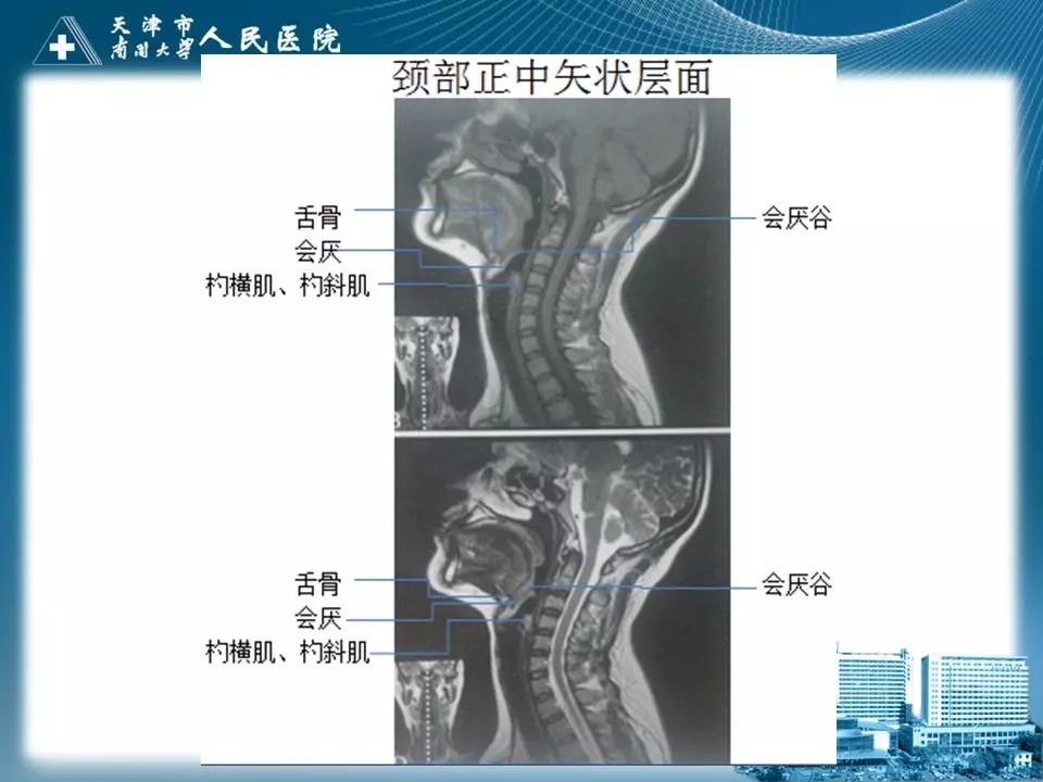影像PPT - 【PPT】喉的应用解剖与影像解剖-33
