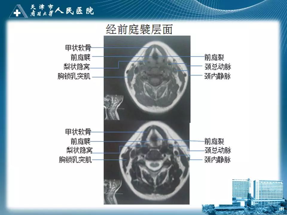 影像PPT - 【PPT】喉的应用解剖与影像解剖-29