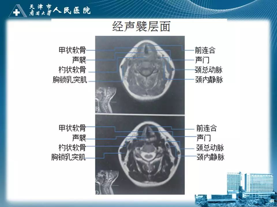 影像PPT - 【PPT】喉的应用解剖与影像解剖-30