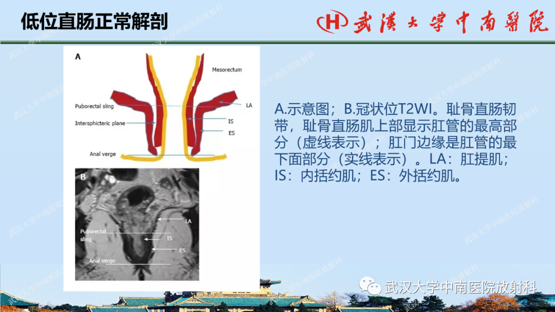 影像PPT - 【PPT】直肠癌的MRI诊断及分期-5