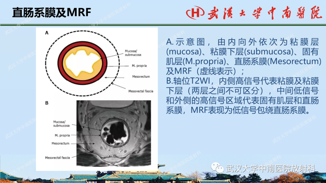 影像PPT - 【PPT】直肠癌的MRI诊断及分期-11