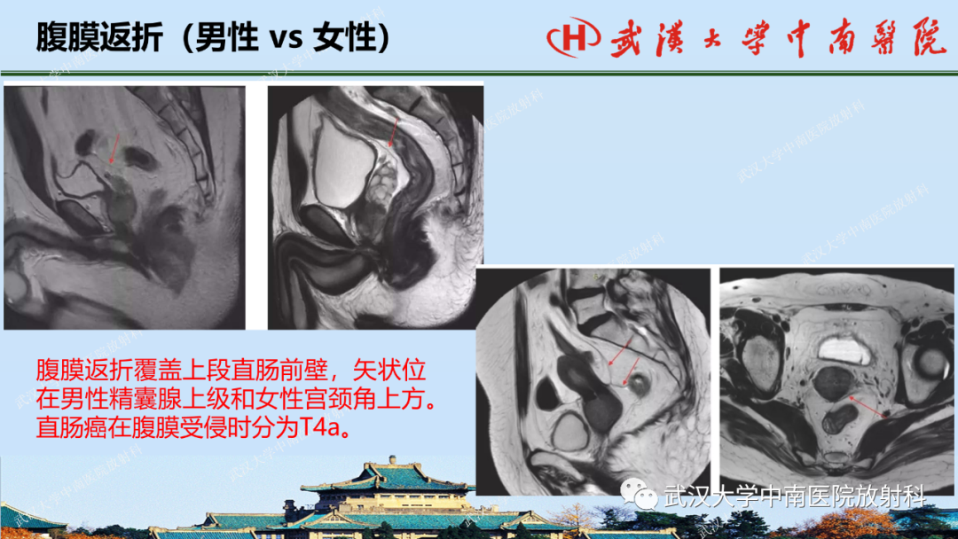 影像PPT - 【PPT】直肠癌的MRI诊断及分期-12