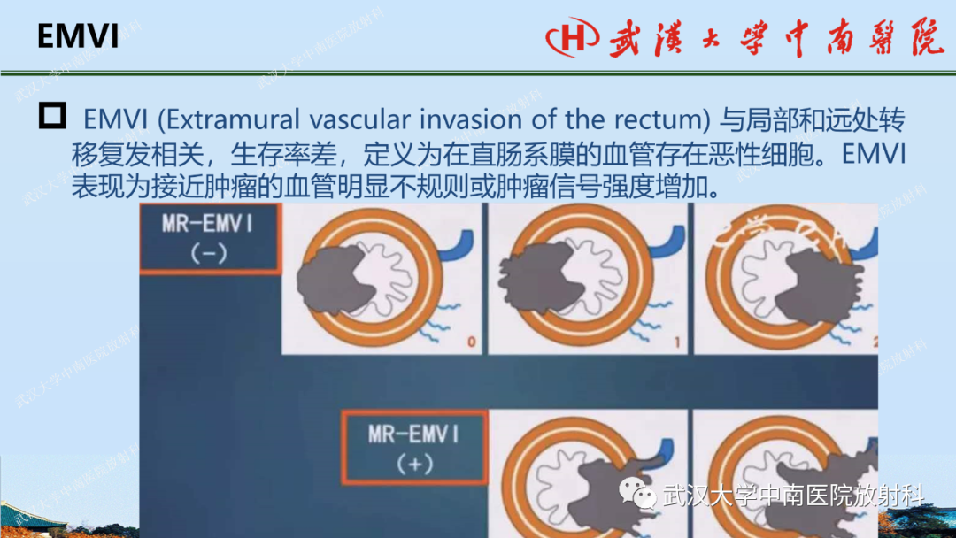 影像PPT - 【PPT】直肠癌的MRI诊断及分期-13