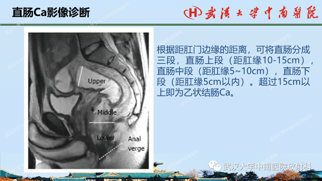 影像PPT - 【PPT】直肠癌的MRI诊断及分期-18