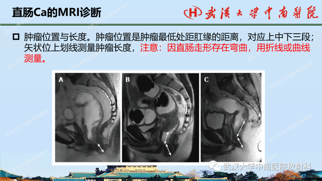 影像PPT - 【PPT】直肠癌的MRI诊断及分期-19