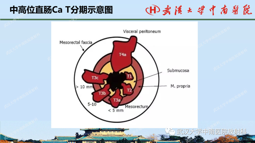 影像PPT - 【PPT】直肠癌的MRI诊断及分期-21