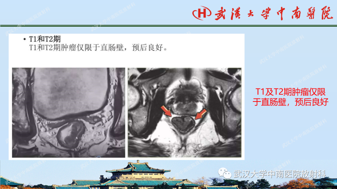 影像PPT - 【PPT】直肠癌的MRI诊断及分期-22