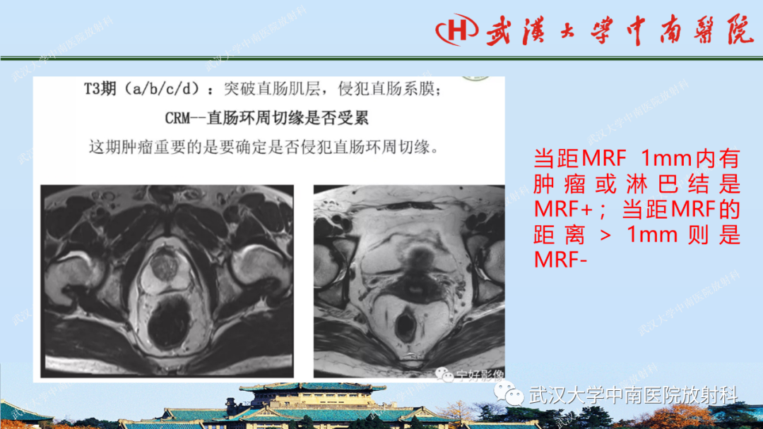 影像PPT - 【PPT】直肠癌的MRI诊断及分期-23