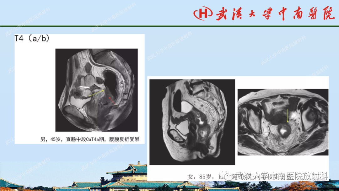影像PPT - 【PPT】直肠癌的MRI诊断及分期-25