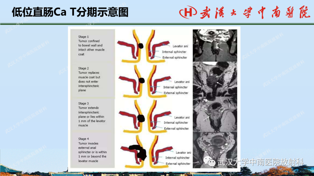 影像PPT - 【PPT】直肠癌的MRI诊断及分期-27