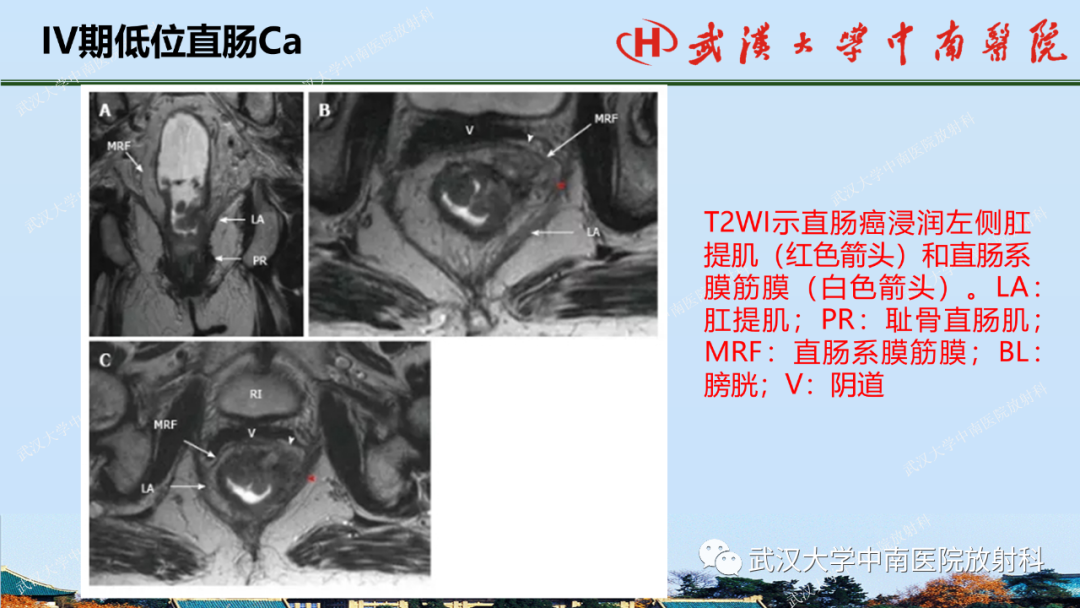 影像PPT - 【PPT】直肠癌的MRI诊断及分期-28