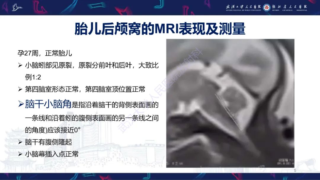 影像PPT - 【PPT】胎儿后颅窝畸形MRI诊断-5
