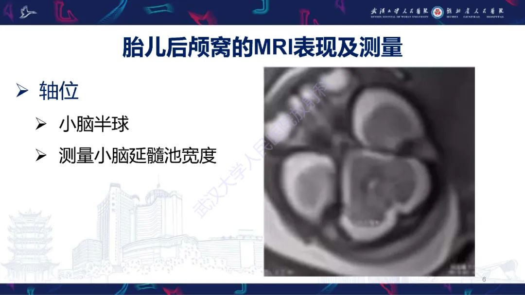 影像PPT - 【PPT】胎儿后颅窝畸形MRI诊断-6