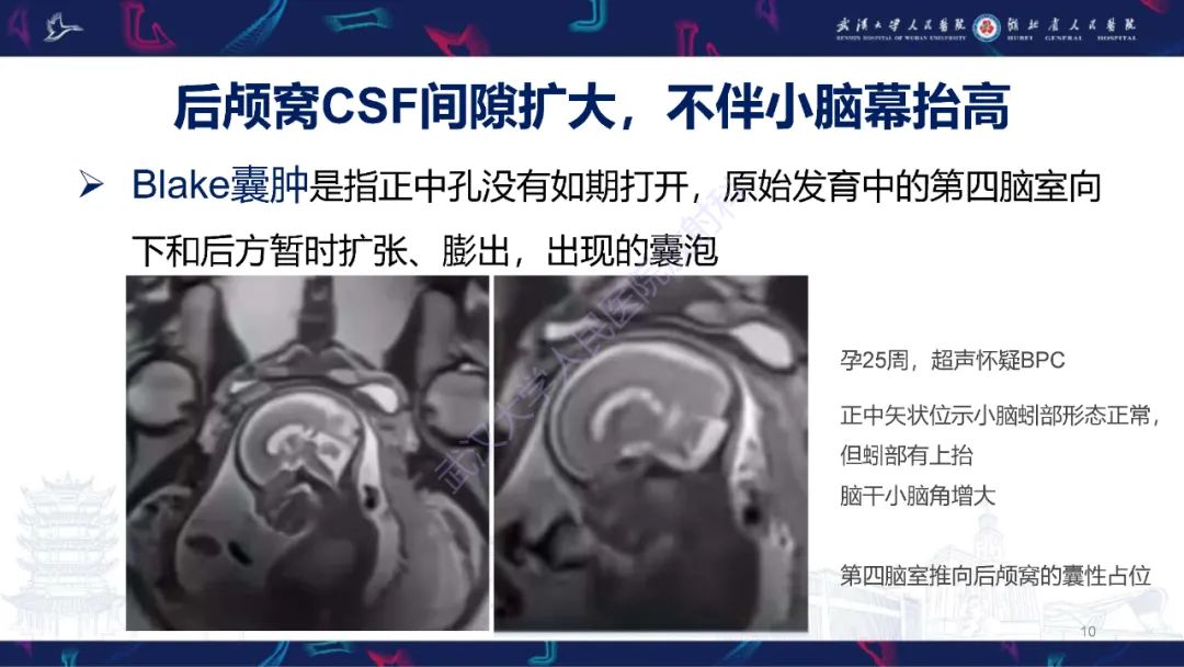 影像PPT - 【PPT】胎儿后颅窝畸形MRI诊断-10