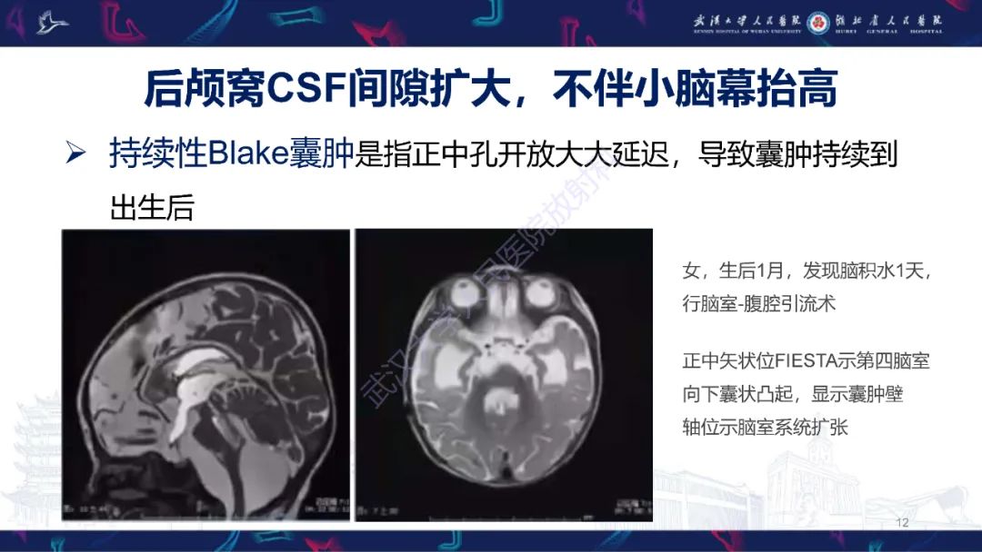 影像PPT - 【PPT】胎儿后颅窝畸形MRI诊断-12