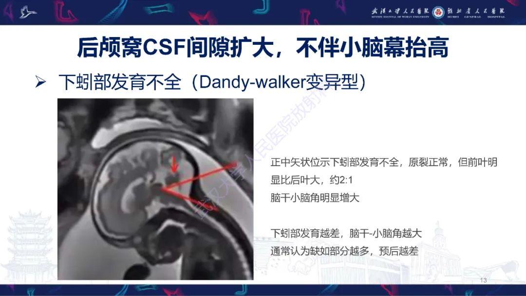 影像PPT - 【PPT】胎儿后颅窝畸形MRI诊断-13