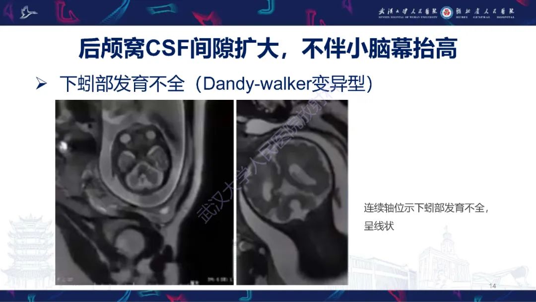 影像PPT - 【PPT】胎儿后颅窝畸形MRI诊断-14