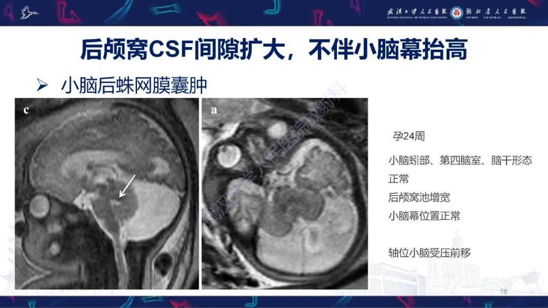 影像PPT - 【PPT】胎儿后颅窝畸形MRI诊断-16