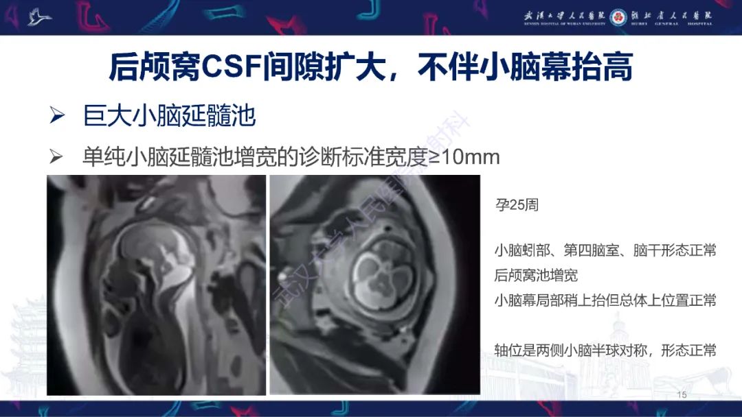 影像PPT - 【PPT】胎儿后颅窝畸形MRI诊断-15