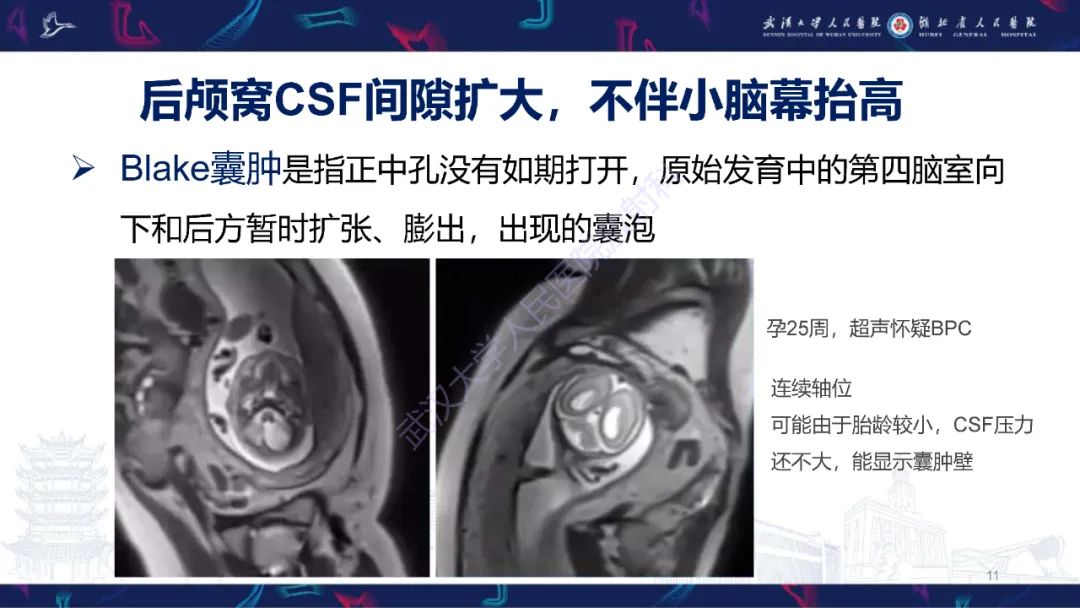 影像PPT - 【PPT】胎儿后颅窝畸形MRI诊断-11