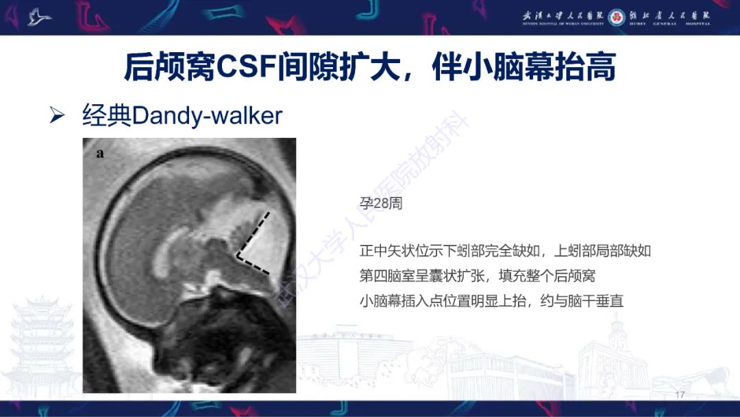 影像PPT - 【PPT】胎儿后颅窝畸形MRI诊断-17